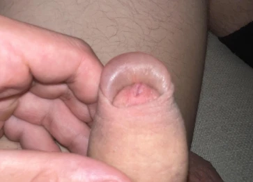 Gonflement après 2 jours