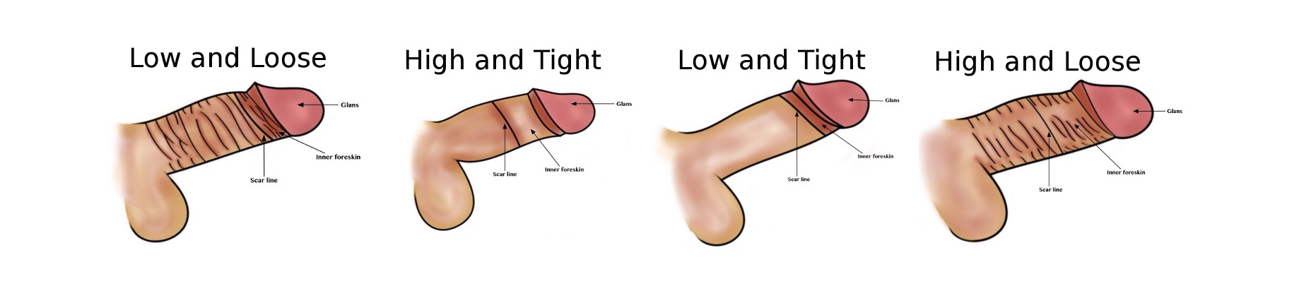 Les différents styles de circoncision